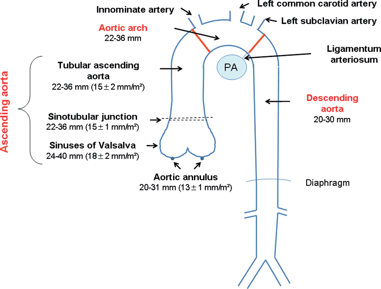 Ektasie der aorta ascendens