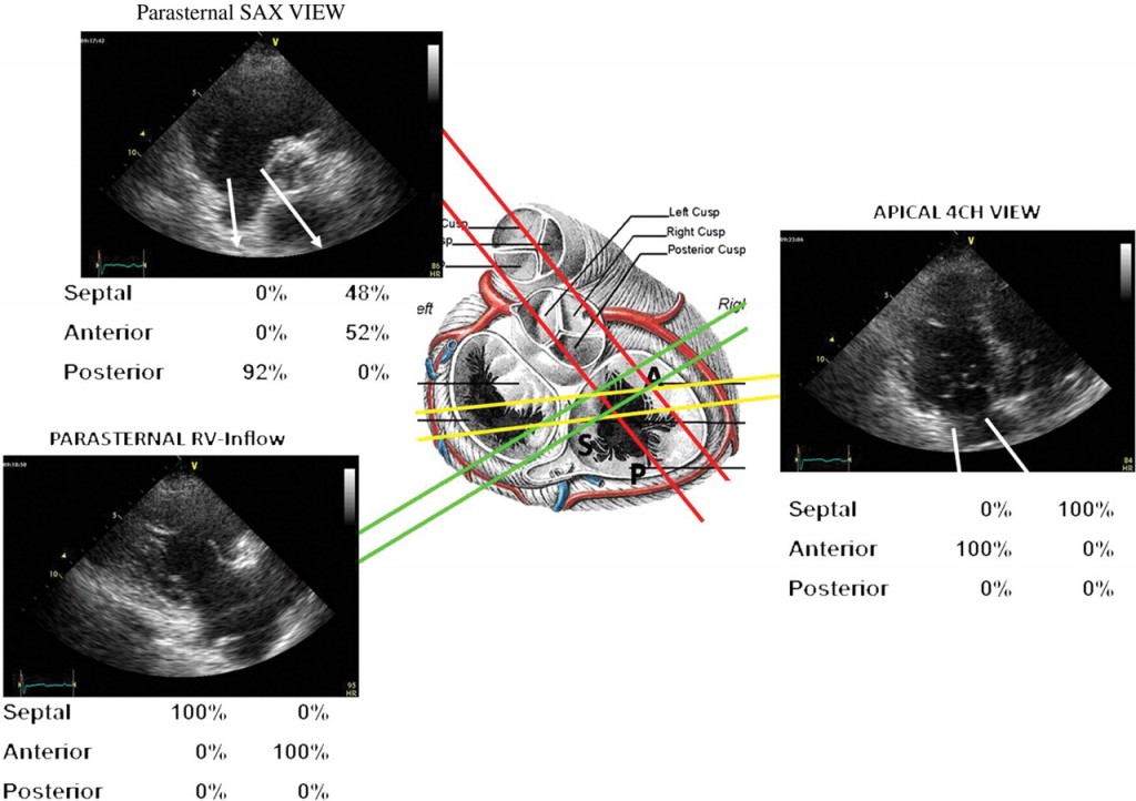 Klepbladen Tricuspidalis Echocardiografie