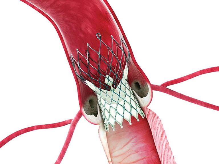 TAVR Harfunctiediagnostiek Nederland tavr-harfunctiediagnostiek-nederland